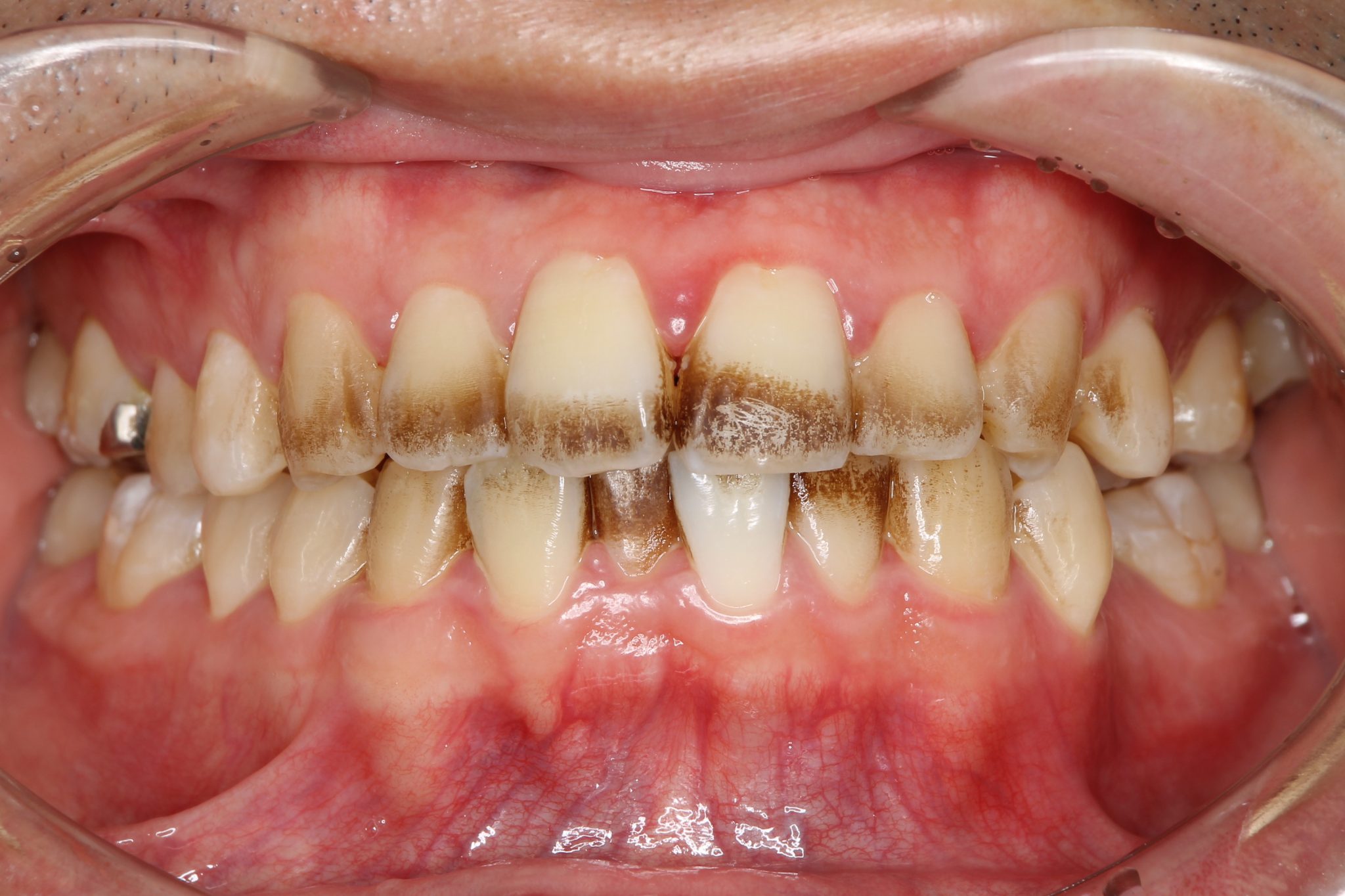 歯の変色 様々な原因と対処 市川市行徳駅からすぐの歯医者 行徳tm歯科